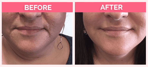 Restylane for Nasolabial folds and Marionette lines.