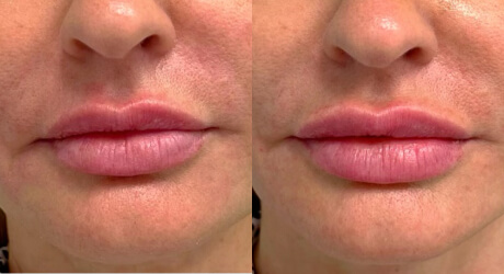 Lip Filler Before & After