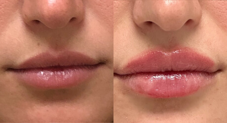 Lip Filler Before & After