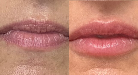 Lip Filler Before & After