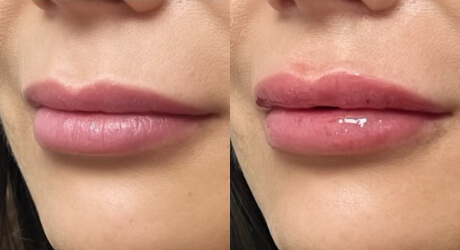 Lip Filler Before & After