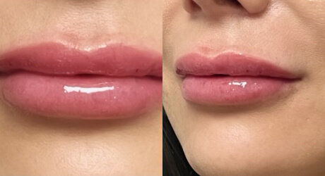 Lip Filler Before & After