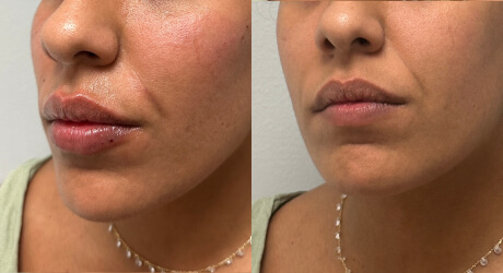 Lip Filler Before & After