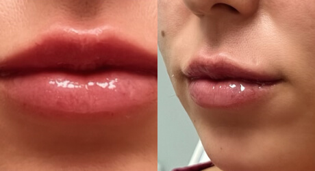 Lip Filler Before & After